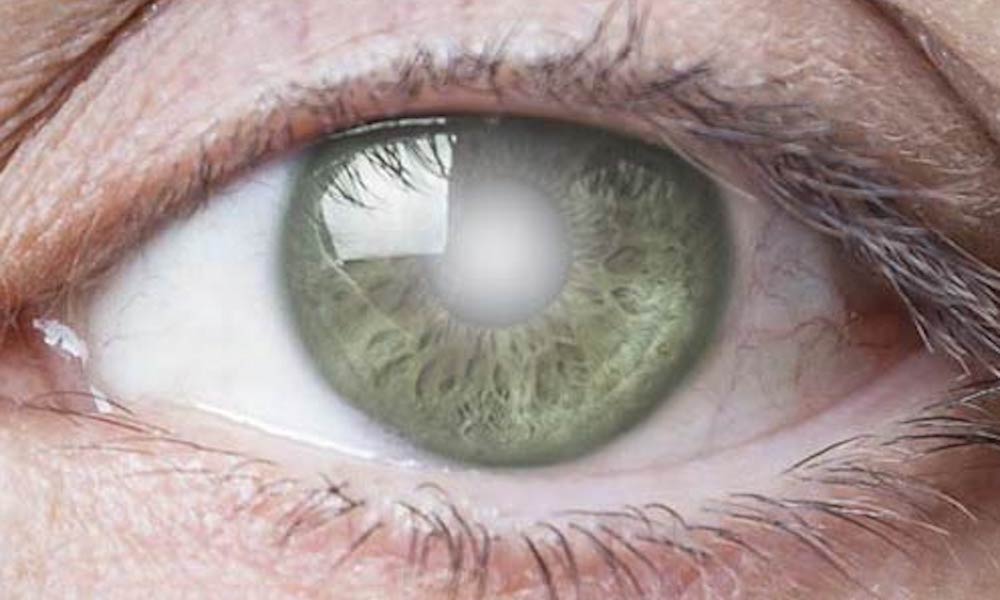 cataract treatment st louis sure vision