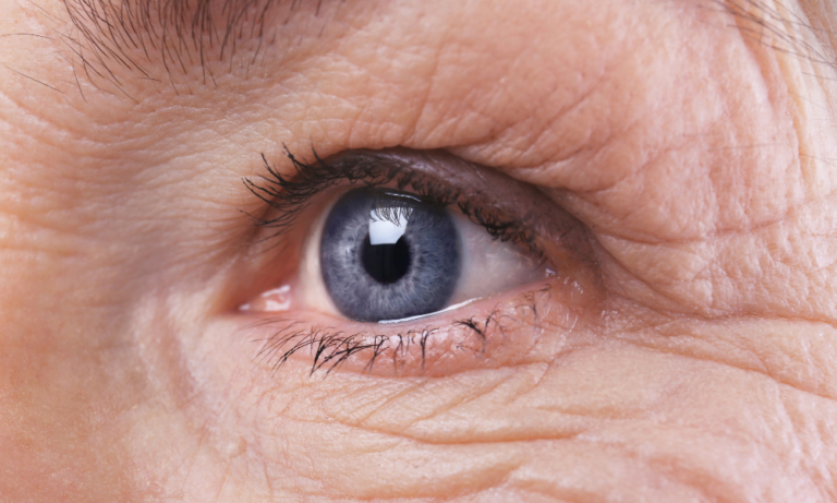 Common Questions After Cataract Surgery Part 2