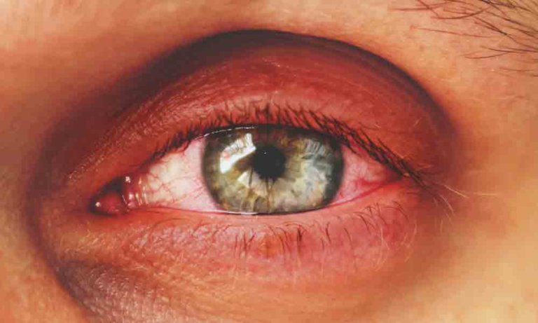 Blepharitis Treatments Surevision Eye Centers 
